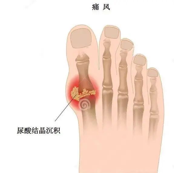 痛风为什么偏爱男性？你最关心的问题都在这里